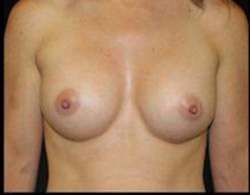 Breast Augmentation Before and After Pictures Pittsburgh, PA