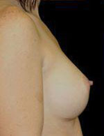 Breast Augmentation Before and After Pictures Pittsburgh, PA