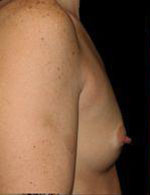 Breast Augmentation Before and After Pictures Pittsburgh, PA