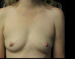 Breast Augmentation Before and After Pictures Pittsburgh, PA