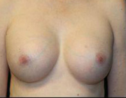 Breast Augmentation Before and After Pictures Pittsburgh, PA