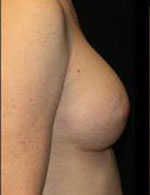 Breast Augmentation Before and After Pictures Pittsburgh, PA