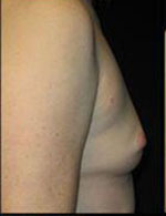 Breast Augmentation Before and After Pictures Pittsburgh, PA