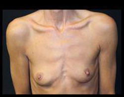 Breast Augmentation Before and After Pictures Pittsburgh, PA