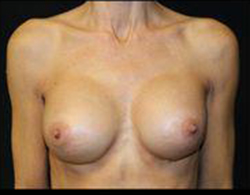 Breast Augmentation Before and After Pictures Pittsburgh, PA