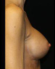 Breast Augmentation Before and After Pictures Pittsburgh, PA