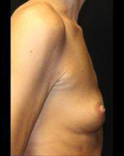 Breast Augmentation Before and After Pictures Pittsburgh, PA