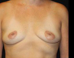 Breast Augmentation Before and After Pictures Pittsburgh, PA