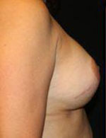 Breast Augmentation Before and After Pictures Pittsburgh, PA