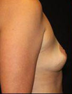 Breast Augmentation Before and After Pictures Pittsburgh, PA