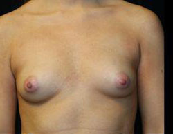 Breast Augmentation Before and After Pictures Pittsburgh, PA