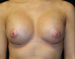 Breast Augmentation Before and After Pictures Pittsburgh, PA