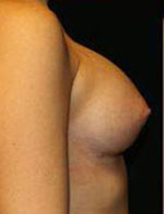 Breast Augmentation Before and After Pictures Pittsburgh, PA