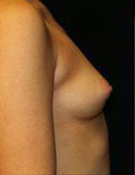 Breast Augmentation Before and After Pictures Pittsburgh, PA