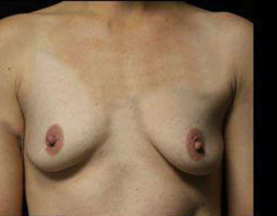 Breast Augmentation Before and After Pictures Pittsburgh, PA