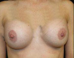 Breast Augmentation Before and After Pictures Pittsburgh, PA