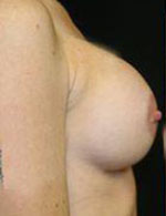 Breast Augmentation Before and After Pictures Pittsburgh, PA