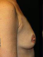 Breast Augmentation Before and After Pictures Pittsburgh, PA