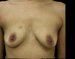 Breast Augmentation Before and After Pictures Pittsburgh, PA