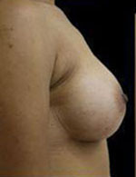 Breast Augmentation Before and After Pictures Pittsburgh, PA