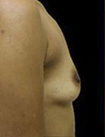 Breast Augmentation Before and After Pictures Pittsburgh, PA