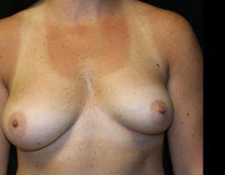 Breast Augmentation Before and After Pictures Pittsburgh, PA