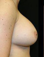 Breast Augmentation Before and After Pictures Pittsburgh, PA