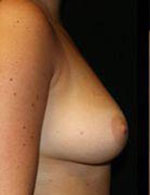 Breast Augmentation Before and After Pictures Pittsburgh, PA