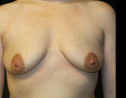 Breast Augmentation Before and After Pictures Pittsburgh, PA