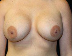 Breast Augmentation Before and After Pictures Pittsburgh, PA