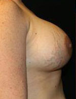 Breast Augmentation Before and After Pictures Pittsburgh, PA