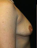 Breast Augmentation Before and After Pictures Pittsburgh, PA