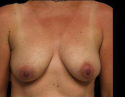 Breast Augmentation Before and After Pictures Pittsburgh, PA