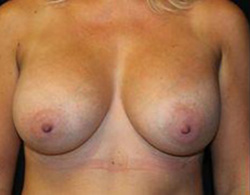 Breast Augmentation Before and After Pictures Pittsburgh, PA