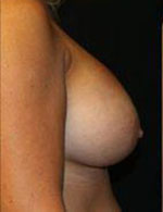 Breast Augmentation Before and After Pictures Pittsburgh, PA