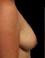 Breast Augmentation Before and After Pictures Pittsburgh, PA