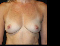 Breast Augmentation Before and After Pictures Pittsburgh, PA