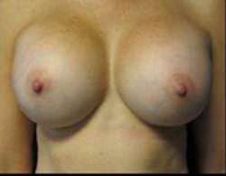 Breast Augmentation Before and After Pictures Pittsburgh, PA