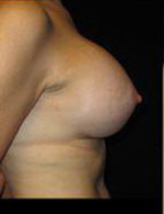 Breast Augmentation Before and After Pictures Pittsburgh, PA