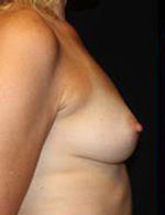 Breast Augmentation Before and After Pictures Pittsburgh, PA