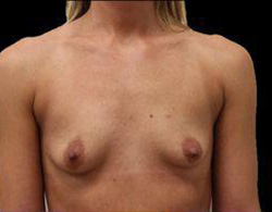 Breast Augmentation Before and After Pictures Pittsburgh, PA