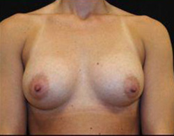 Breast Augmentation Before and After Pictures Pittsburgh, PA