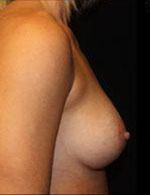 Breast Augmentation Before and After Pictures Pittsburgh, PA