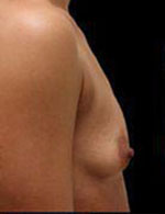 Breast Augmentation Before and After Pictures Pittsburgh, PA