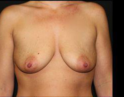 Breast Augmentation Before and After Pictures Pittsburgh, PA