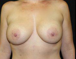 Breast Augmentation Before and After Pictures Pittsburgh, PA