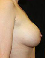 Breast Augmentation Before and After Pictures Pittsburgh, PA