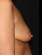 Breast Augmentation Before and After Pictures Pittsburgh, PA