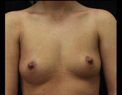 Breast Augmentation Before and After Pictures Pittsburgh, PA