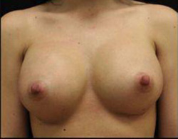 Breast Augmentation Before and After Pictures Pittsburgh, PA